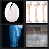  Fracture 